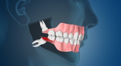 wisdom tooth extraction dubai 4