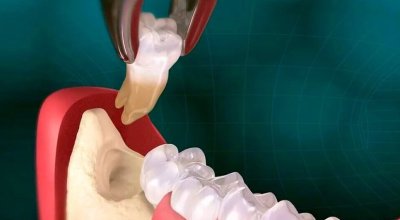 wisdom tooth extraction dubai 5