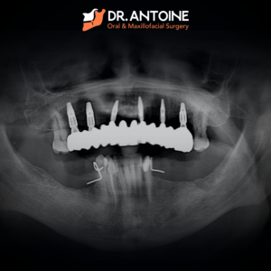 Dr Antoine BA X Ray F 03 1