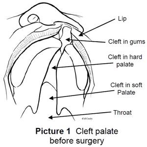 Surgery for Cleft Lip and Palate