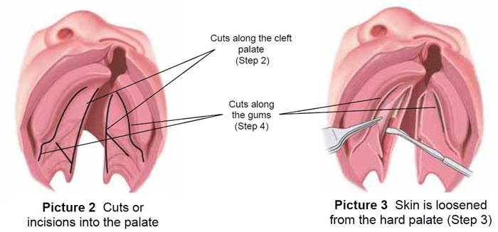 Surgery for Cleft Lip and Palate