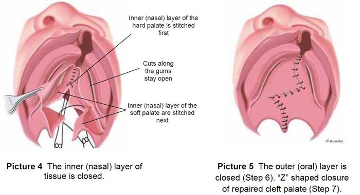 Surgery for Cleft Lip and Palate