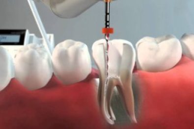 root canal specialist dubai (1)