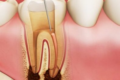 root canal specialist dubai (2)