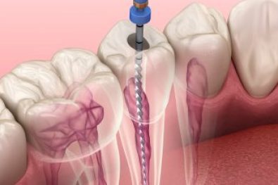 root canal specialist dubai (3)