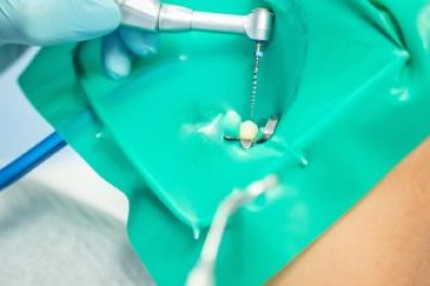 root canal specialist dubai (4)