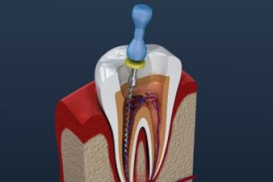 root canal specialist dubai